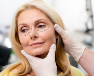 Blefaroplastia.